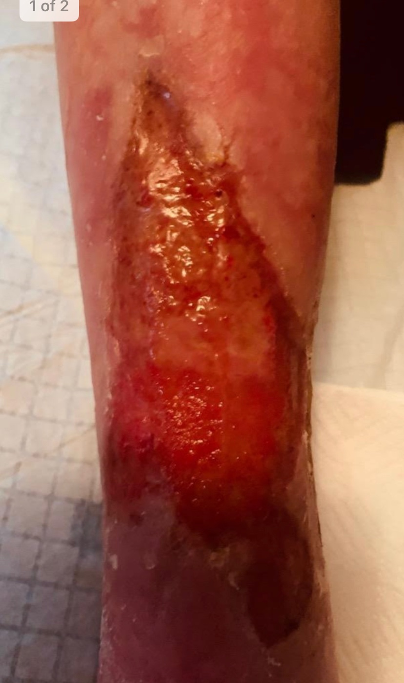 Top wound following 2 1/2 years of traditional wound treatment.
