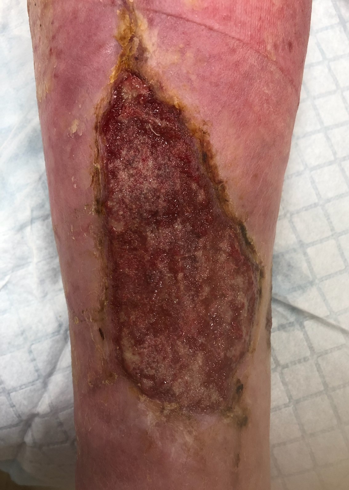 Top wound following first treatment plan with Restore First Health