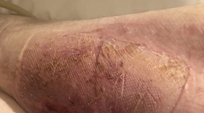 Left leg after 21 days of treatment with Restore First Health